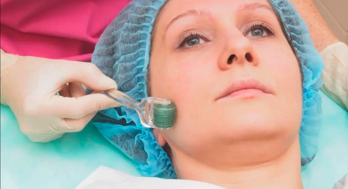 micro-needling-vs-botox-which-treatment-wins